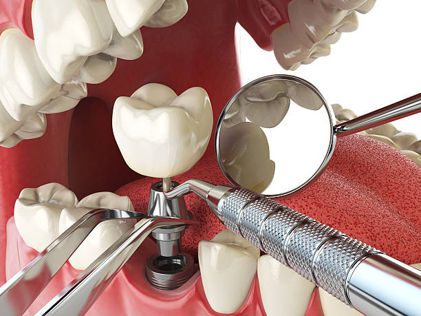 Best Broken or Chipped Tooth Repair in Northville, NY